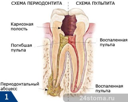 Схема периодонтита, а также его отличия от пульпита зуба