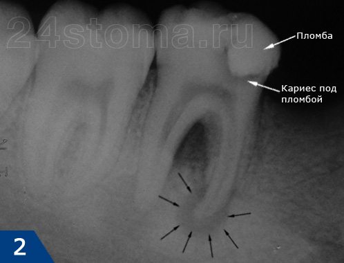 Хронический гранулематозный периодонтит на рентгеновском снимке (периодонтальный абсцесс в виде гранулемы - ограничен черными стрелками)