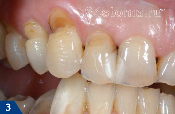 Клиновидные дефекты верхних зубов