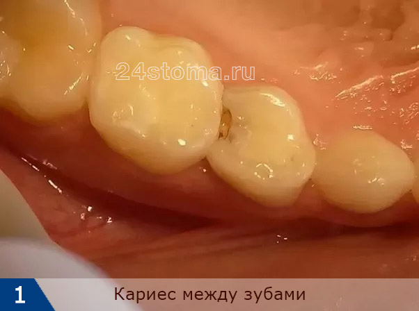 Кариес между зубами (пятый премоляр верхней челюсти)