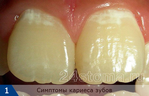 Симптомы кариеса зубов: в стадии белого пятна