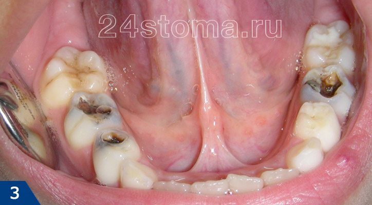 Глубокие кариозные полости на трех нижних зубах