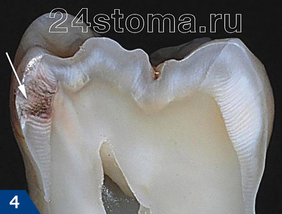 Вид поверхностного кариеса на распиле зуба