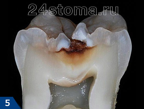 Вид среднего кариеса на распиле зуба