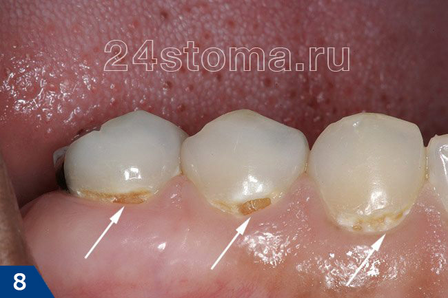 Пришеечный кариес в области 3-х зубов