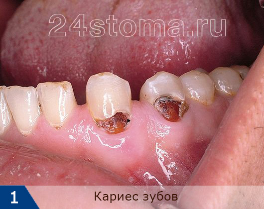 Кариес зубов: пришеечный кариес зубов нижней челюсти