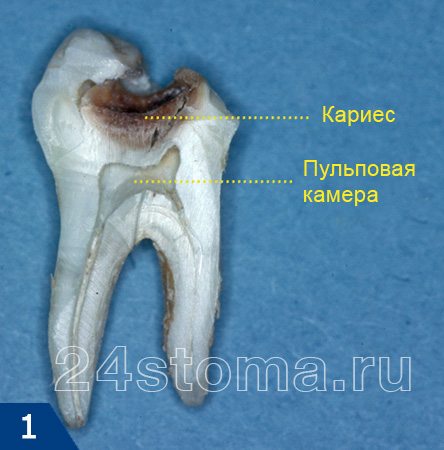 Вид зуба, пораженного кариесом на распиле