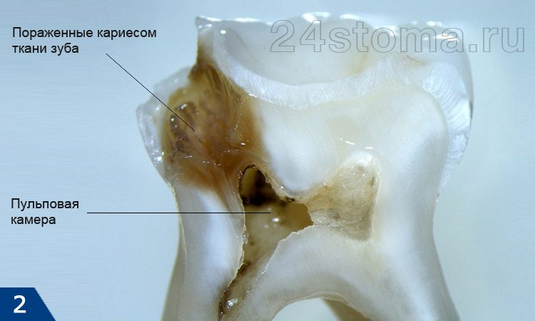 Пульпит зуба: ткани зуба поражены кариесом на всю глубину (до пульповой камеры, где расположена пульпа зуба)