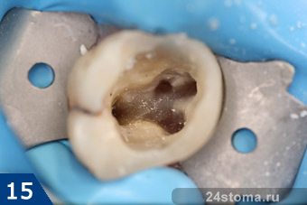 Механическая обработка корневых каналов при лечении зубов thumbnail