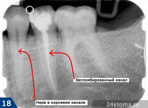 Вид запломбированных и не запломбированных корневых каналов на рентгенограмме
