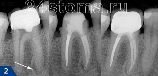 Фиброзный пульпит лечение. Пломбировка корневых каналов рентген. Периодонтит запломбированные каналы.