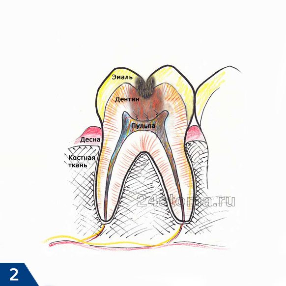 Исходная ситуация: воспаление пульпы зуба, требующее удаления нерва и пломбирования корневых каналов