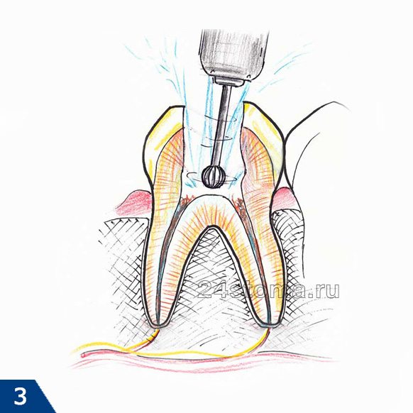 Высверливание кариозных тканей, а также тканей зуба, нависающих над устьями корневых каналов
