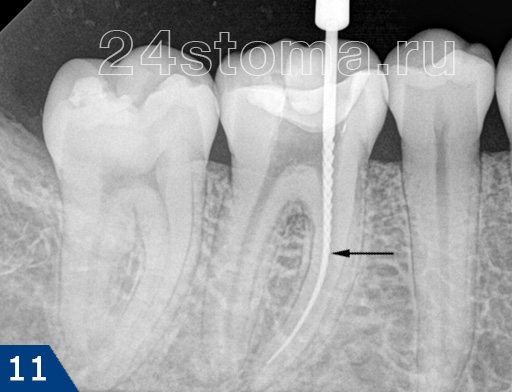 Вид К-файла (указан стрелочкой) в корневом канале зуба