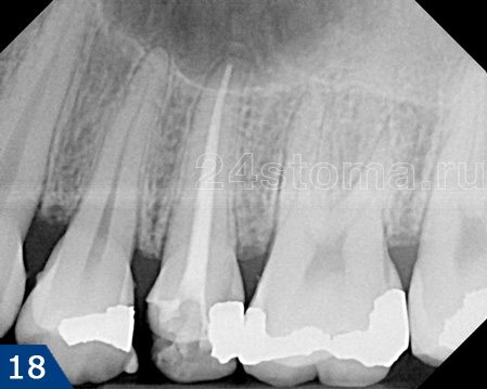 Рентгенограмма зуба после пломбирования корневого канала гуттаперчей.