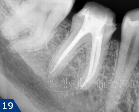 Рентгенограмма 2х корневого зуба с тремя каналами, котрые были запломбированы гуттаперчей