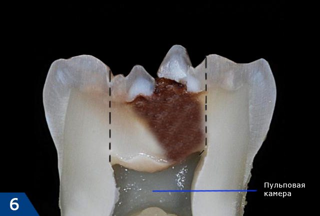 Границы препарирования тканей зуба при пульпите (отмечены пунктирной линией)