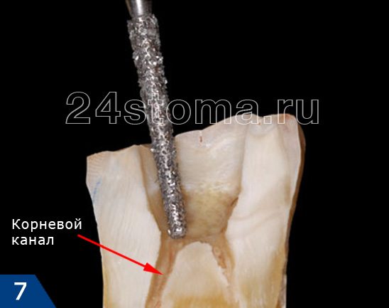 Вид зуба после окончания препарирования: вскрыта пульповая камера, обнажены устья корневых каналов