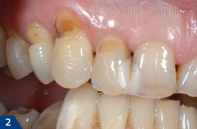 Клиновидные дефекты зубов