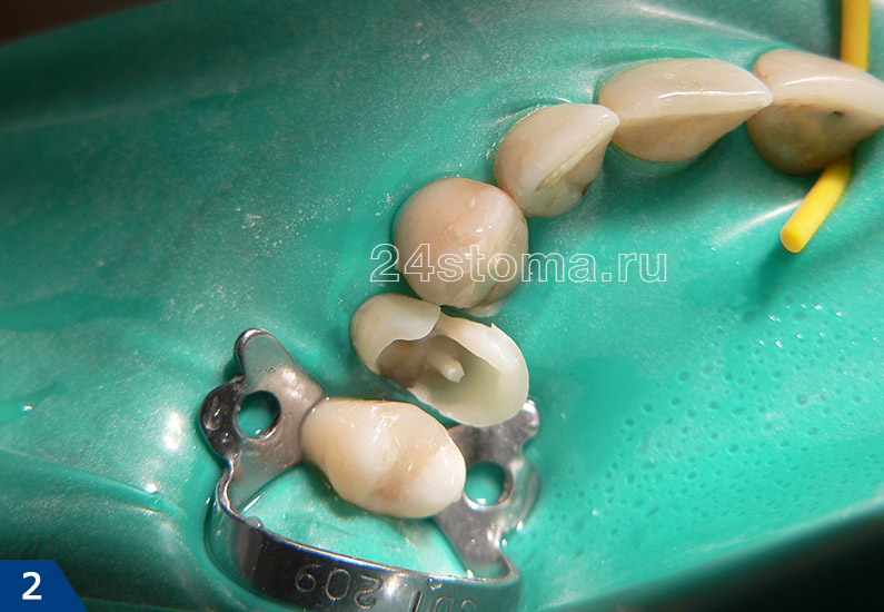 Реставрация 14 зуба (на этом этапе в корневой канал установлен стекловолоконный штифт)