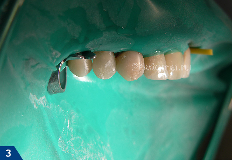Реставрация 14 зуба (закончено восстановление формы зуба, далее будет этап шлифовки и полировки)