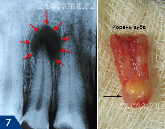 Гранулёматозная форма хронического периодонтита на рентгеновском снимке (у верхушки корня очаг затемнения с четкими контурами) и на верхушке корня удаленного зуба.