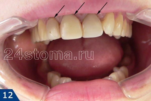 Некачественные реставрации трех верхних зубов (зубы выглядят как пластмассовые коронки после 3х лет экплуатации)