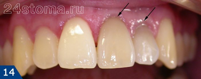Некачественные реставрации двух верхних резцов (несовпадение цвета - зубы более темные и тусклые по сравнению с другими зубами)