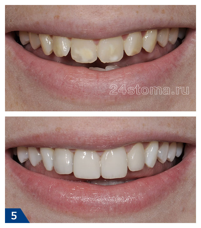 Чтобы скрыть дисколорит эмали зубов - изготовлены композитные виниры на 4 передних зуба (остальные зубы подвергнуты химическому отбеливанию)