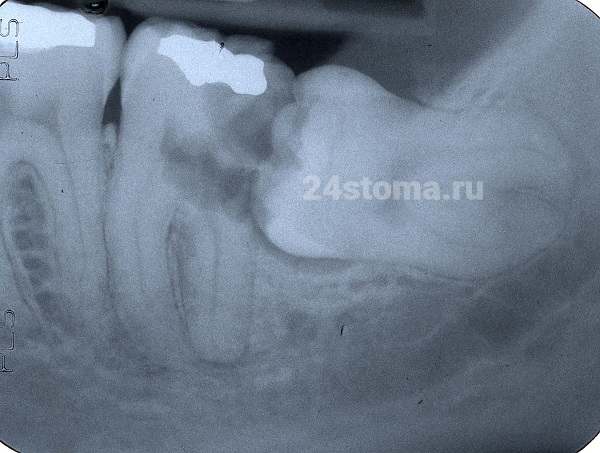 Очаги затемнения на фоне коронки 7 зуба - говорят о ее частичном разрушении