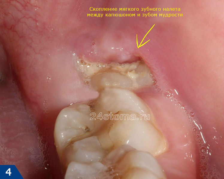 На фото хорошо видна причина развития воспаления десны над зубом мудрости - мягкий микробный зубной налетричина развития