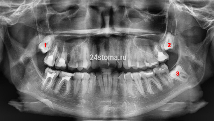Вид зубов мудрости на рентгеновском снимке (цифры 1,2,3). Один зуб мудрости у пациента был удален.