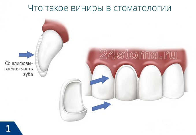 Что такое виниры на зубы (схема обработки зуба под винир и его фиксация)