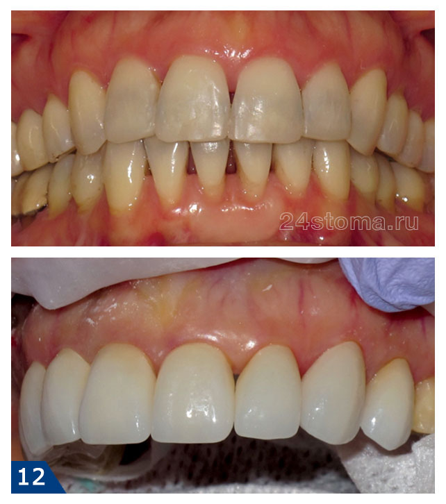 Виниры на 8 передних верхних зубов из E.max CAD - фото до и после