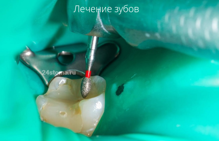 Лечение зубов (на снимке наконечник бормашины с алмазным бором, зуб изолирован от полости рта коффердамом)