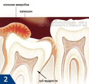 Схема развития перикоронита (воспаления десны) у зуба мудрости