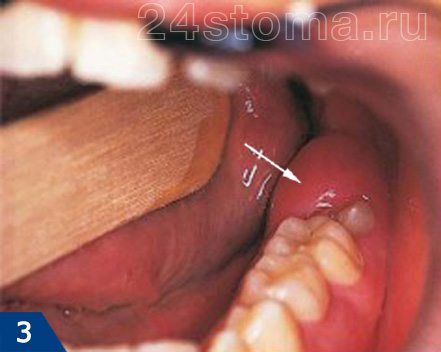 Перикоронит - воспаление капюшона над зубом мудрости (капюшон показан стрелкой)