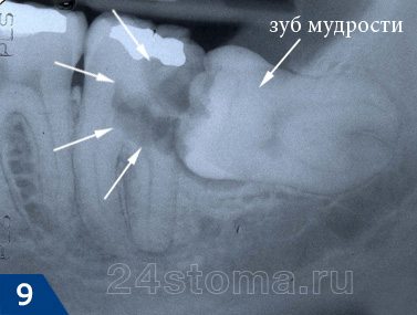 Кариес 7-го зуба (очаг ограничен белыми стрелками), осложненный периодонтитом