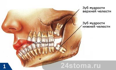 Схема расположения прорезывающихся зубов мудрости