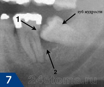 Кариес 7-го зуба (показан стрелкой №1) и разрушение костной ткани (стрелка №2), вызванные зубом мудрости
