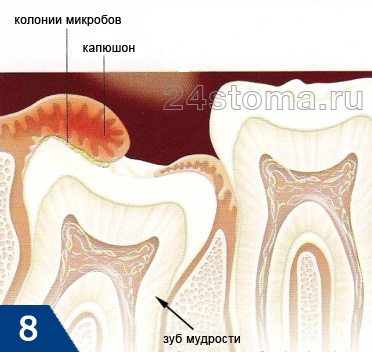 Схема развития воспаления капюшона над зубом мудрости (Перикоронит)