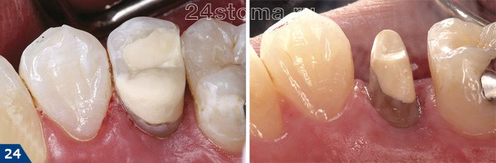 Вид зуба "до и после" его обтачивания под металлокерамическую коронку