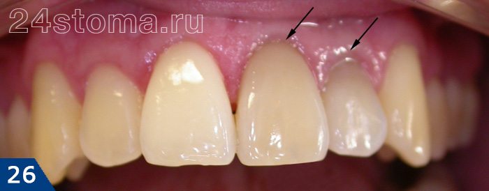 Отличие реставрированных зубов (отмечены стелочками) от естественных по цвету и прозрачности