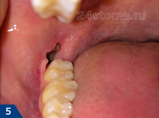 Воспаление лунки удаленного зуба мудрости (альвеолит). В лунке полностью отсутствует кровяной сгусток.