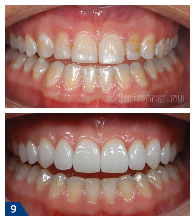 Виниры на 10 передних верхних зубов из E.max PRESS - фото до и после