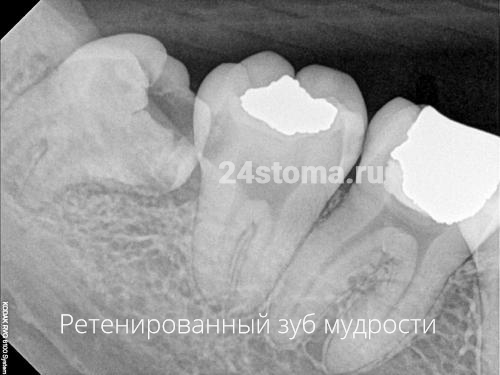 Ретенированный зуб мудрости на нижней челюсти (зуб прорезался над слизистой оболочкой только частью коронки, остальная половина коронки упирается в шейку 7 зуба)