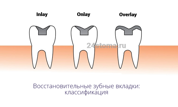 Восстановительные зубные вкладки делят на 3 типа (Inlay,Onlay, Overlay) - согласно тому, какой объем поверхностей зуба они занимают