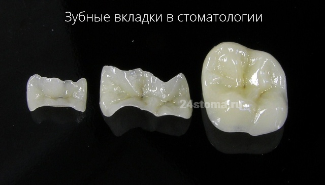 Керамические зубные вкладки в стоматологии