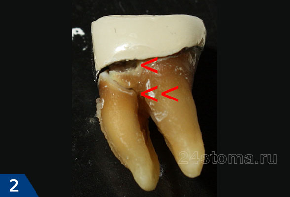 Кариозное поражение корня зуба и тканей зуба под металлокерамической коронкой (плюс перелом корня зуба вследствие кариозного процесса) 