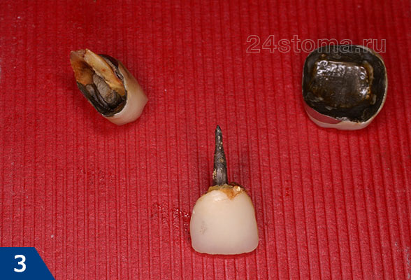 Коронка зуба может выпасть в результате перелома тканей зуба под коронкой (вверху слева), коронка может выпасть просто в результате расцементировки (вверху справа). Внизу - вид коронки,выпавшей вместе с штифтом.